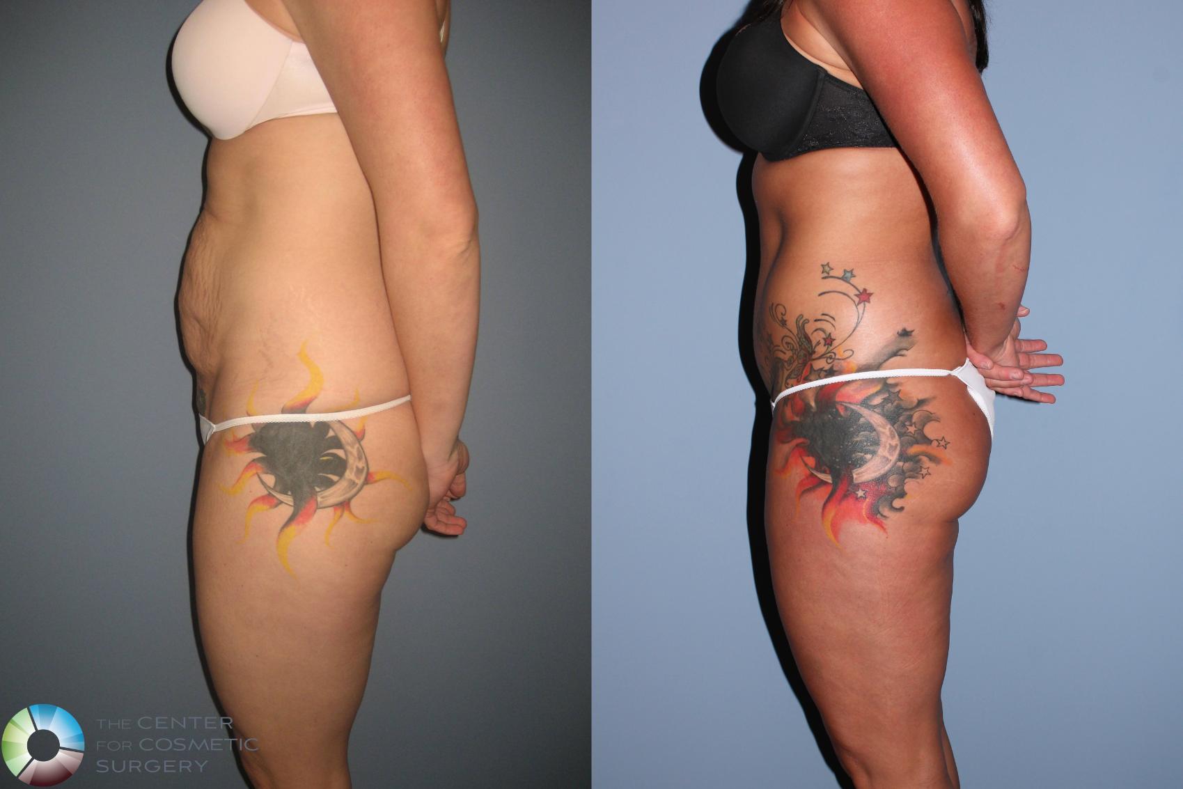 Before & After Tummy Tuck Case 490 View #3 in Denver and Colorado Springs, CO