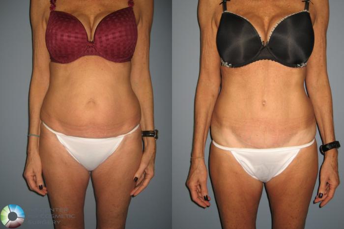 Before & After Tummy Tuck Case 491 View #1 in Denver and Colorado Springs, CO