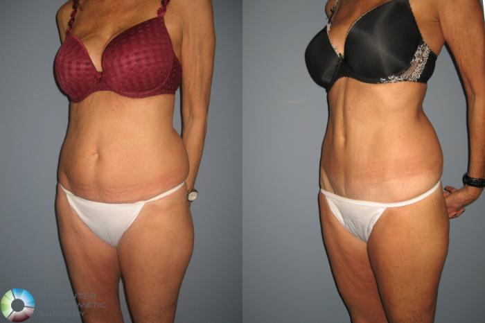 Before & After Tummy Tuck Case 491 View #2 in Denver and Colorado Springs, CO