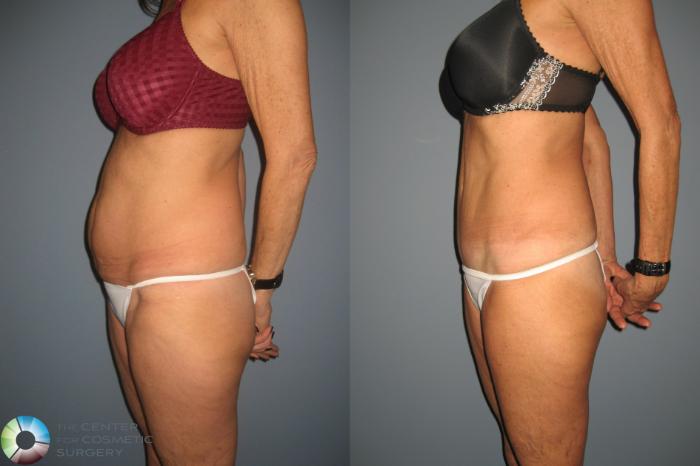 Before & After Tummy Tuck Case 491 View #3 in Denver and Colorado Springs, CO