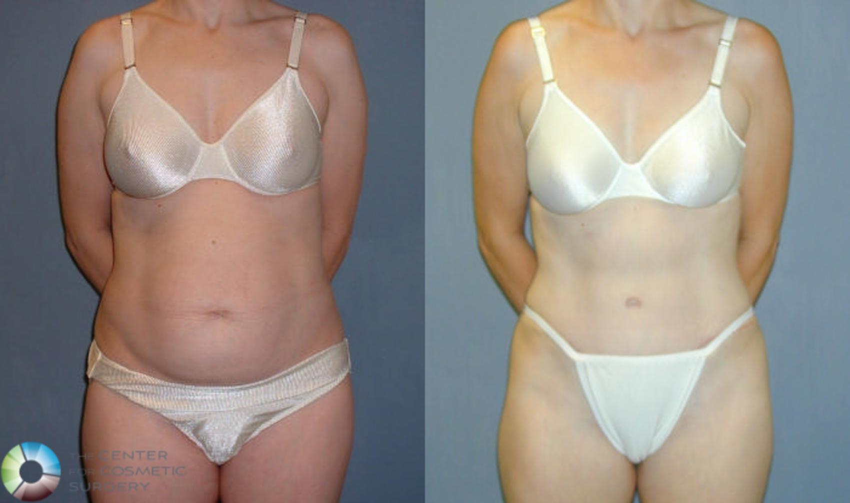 Before & After Tummy Tuck Case 51 View #1 in Denver and Colorado Springs, CO