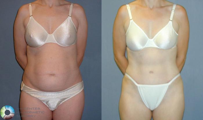 Before & After Tummy Tuck Case 51 View #1 View in Golden, CO