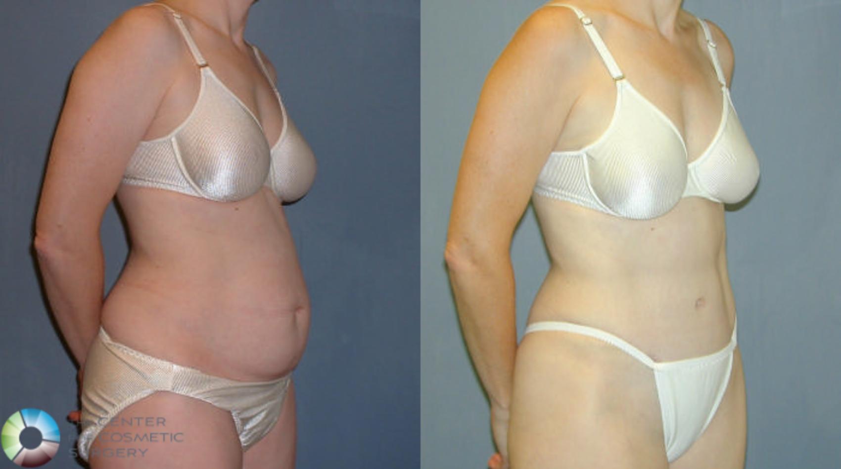 Before & After Tummy Tuck Case 51 View #2 View in Golden, CO