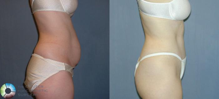 Before & After Tummy Tuck Case 51 View #3 View in Golden, CO