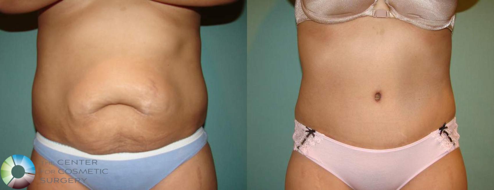 Before & After Tummy Tuck Case 550 View #1 in Denver and Colorado Springs, CO