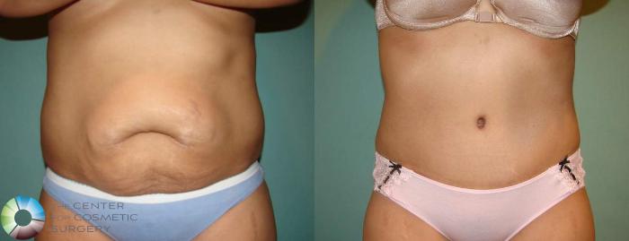 Before & After Tummy Tuck Case 550 View #1 View in Golden, CO
