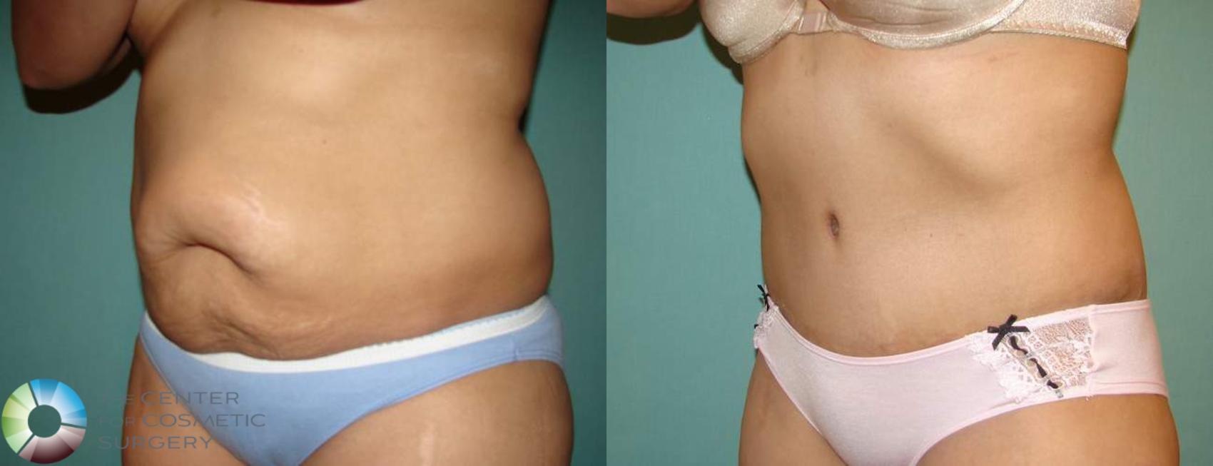 Before & After Tummy Tuck Case 550 View #2 View in Golden, CO