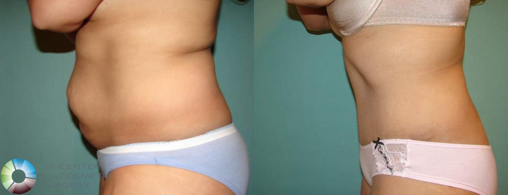 Before & After Tummy Tuck Case 550 View #3 View in Golden, CO