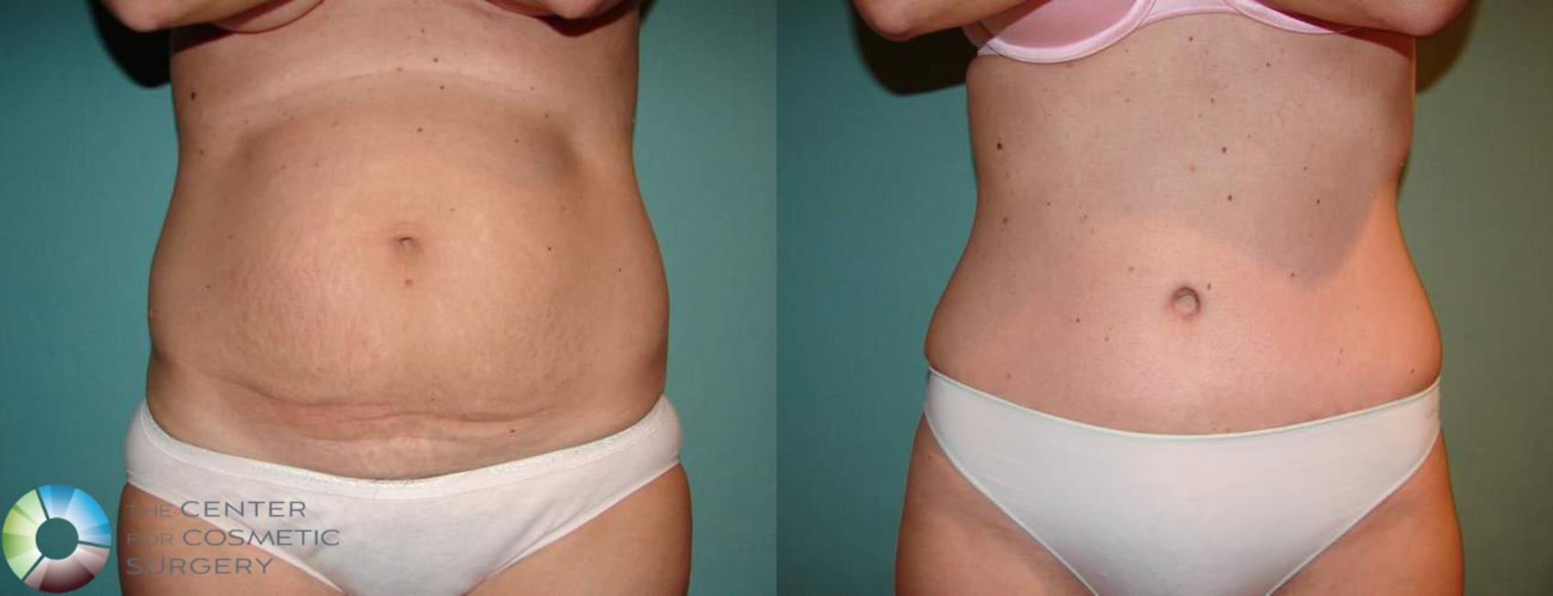 Tummy Tuck Denver - Abdominoplsaty Highlands Ranch