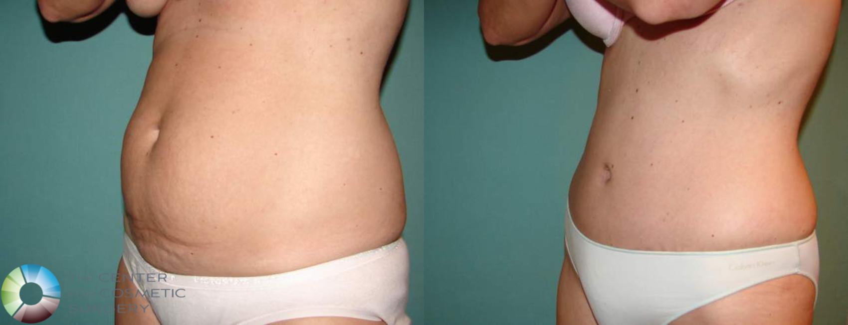 Before & After Tummy Tuck Case 551 View #2 View in Denver & Golden, CO