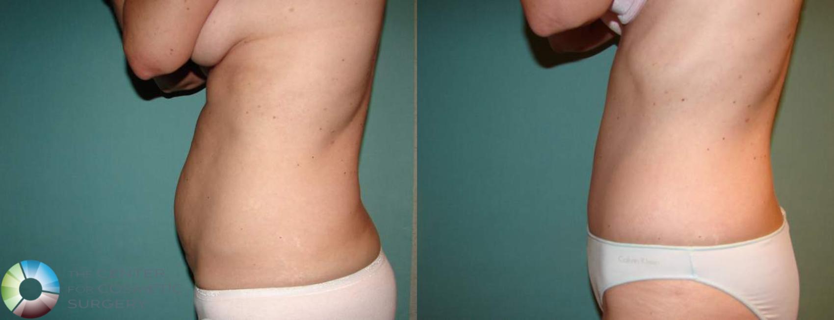 Before & After Tummy Tuck Case 551 View #3 in Denver and Colorado Springs, CO