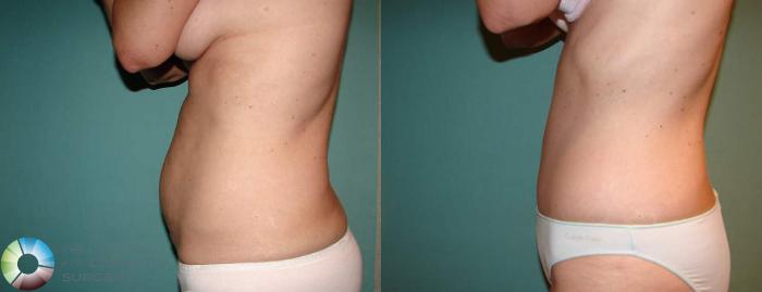 Before & After Tummy Tuck Case 551 View #3 View in Golden, CO