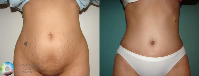 Before & After Tummy Tuck Case 552 View #1 in Denver and Colorado Springs, CO