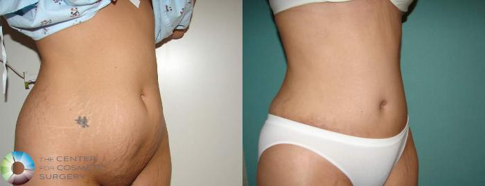 Before & After Tummy Tuck Case 552 View #2 in Denver and Colorado Springs, CO
