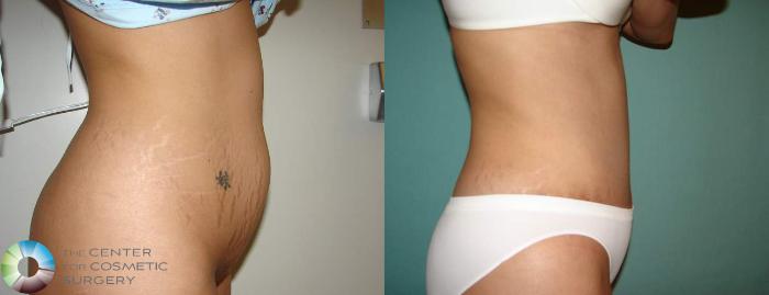 Before & After Tummy Tuck Case 552 View #3 in Denver and Colorado Springs, CO