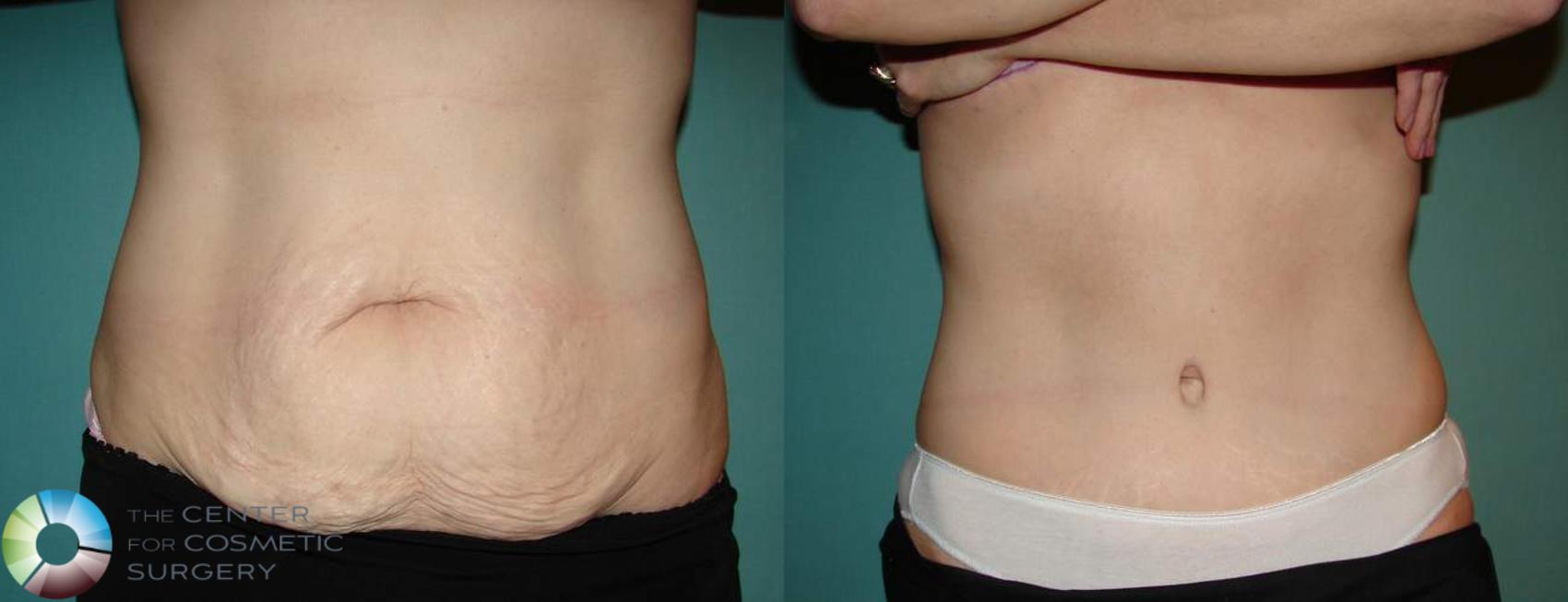 Before & After Tummy Tuck Case 553 View #1 in Denver and Colorado Springs, CO