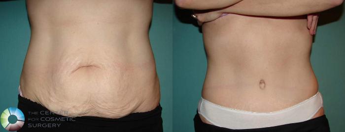 Before & After Tummy Tuck Case 553 View #1 View in Golden, CO