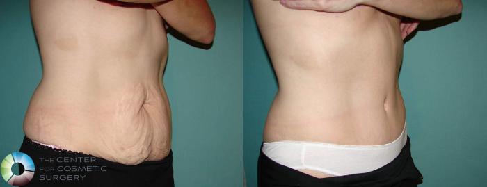 Before & After Tummy Tuck Case 553 View #2 View in Golden, CO