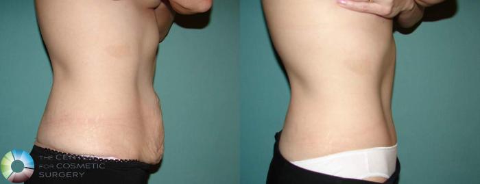 Before & After Tummy Tuck Case 553 View #3 View in Golden, CO