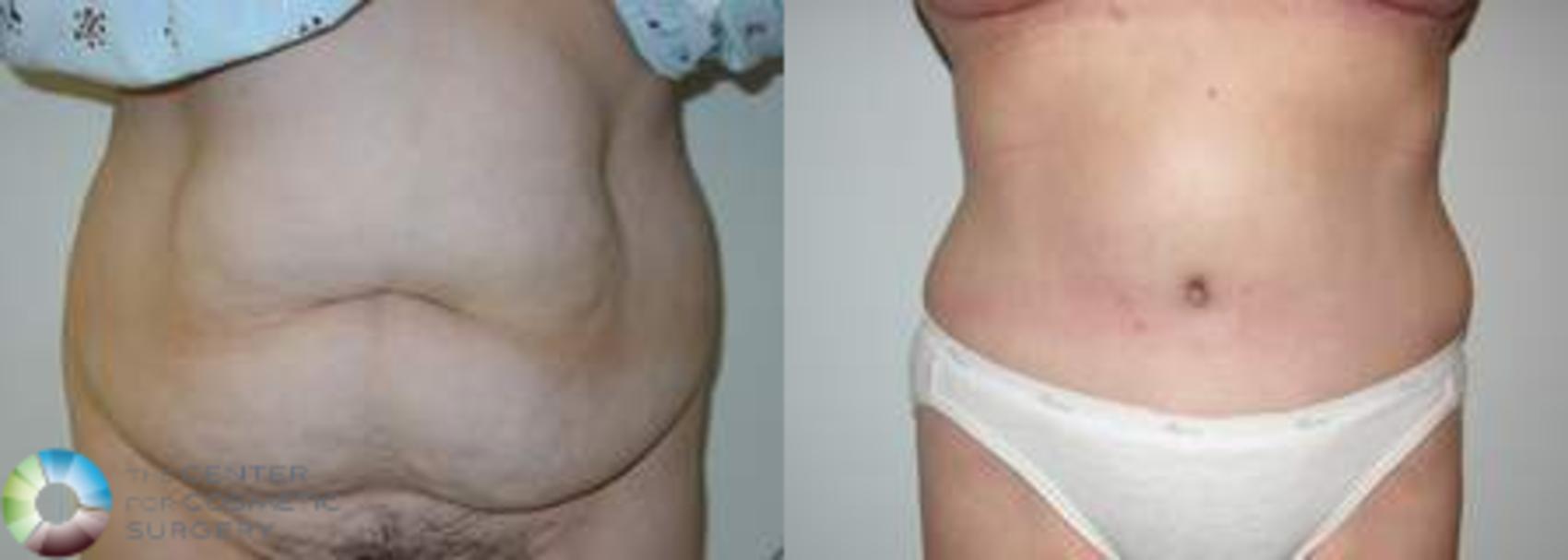 Before & After Tummy Tuck Case 554 View #1 View in Golden, CO