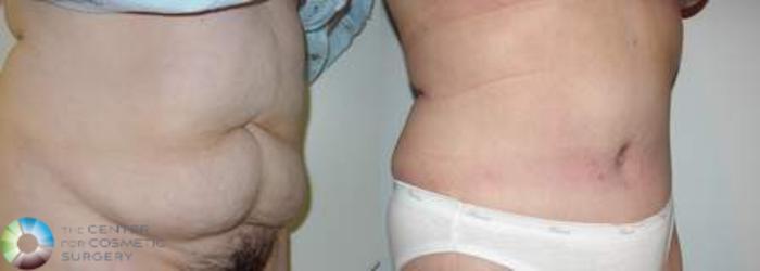 Before & After Tummy Tuck Case 554 View #2 in Denver, CO