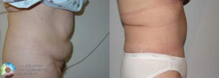 Before & After Tummy Tuck Case 554 View #3 in Denver, CO