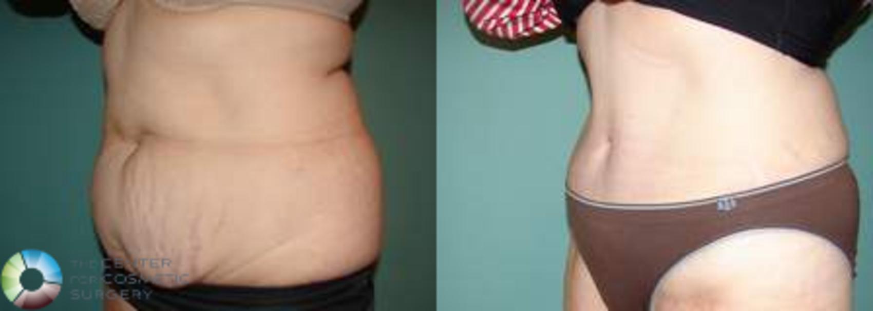 Before & After Tummy Tuck Case 556 View #1 in Denver and Colorado Springs, CO