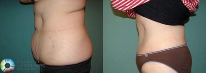 Before & After Tummy Tuck Case 556 View #2 View in Golden, CO