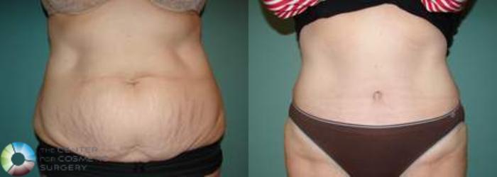 Before & After Tummy Tuck Case 556 View #3 View in Golden, CO