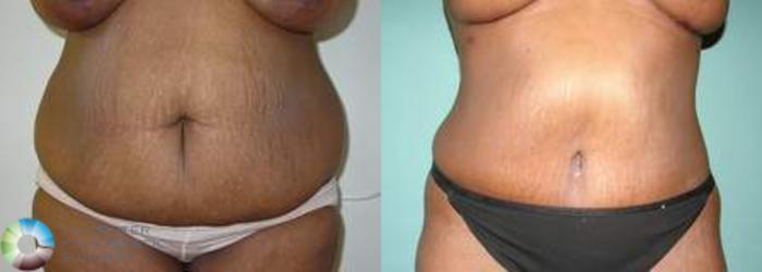 Before & After Tummy Tuck Case 557 View #1 in Denver and Colorado Springs, CO
