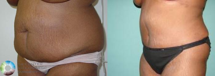 Before & After Tummy Tuck Case 557 View #2 in Denver and Colorado Springs, CO