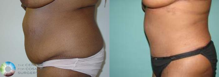 Before & After Tummy Tuck Case 557 View #3 in Denver and Colorado Springs, CO