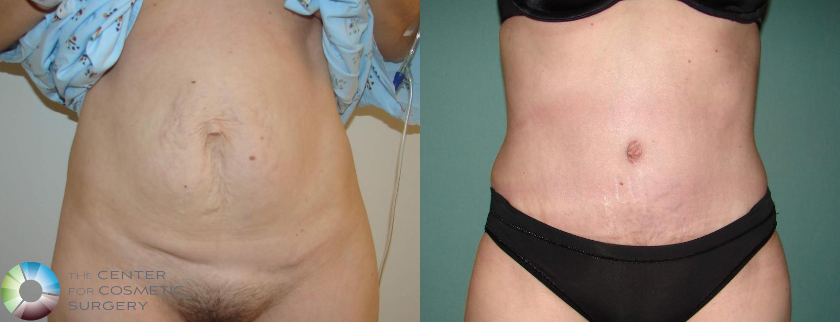 Before & After Tummy Tuck Case 621 View #1 in Denver and Colorado Springs, CO