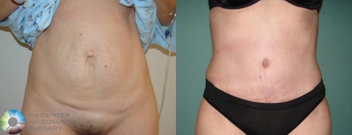 Before & After Tummy Tuck Case 621 View #1 View in Golden, CO