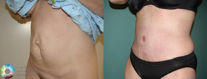 Before & After Tummy Tuck Case 621 View #2 View in Golden, CO