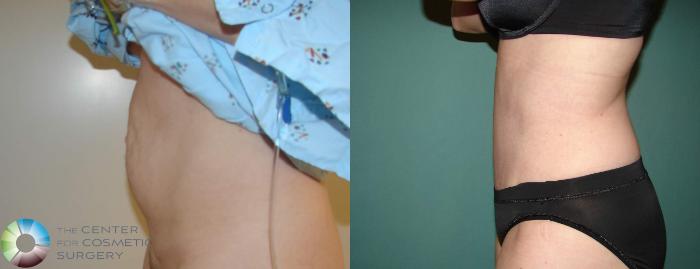 Before & After Tummy Tuck Case 621 View #3 View in Golden, CO