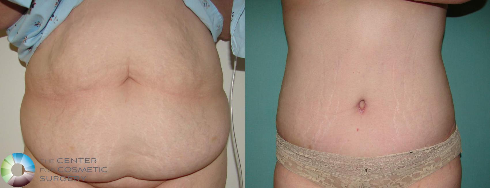 Tummy Tuck Before and After Pictures Case 639, Denver, CO