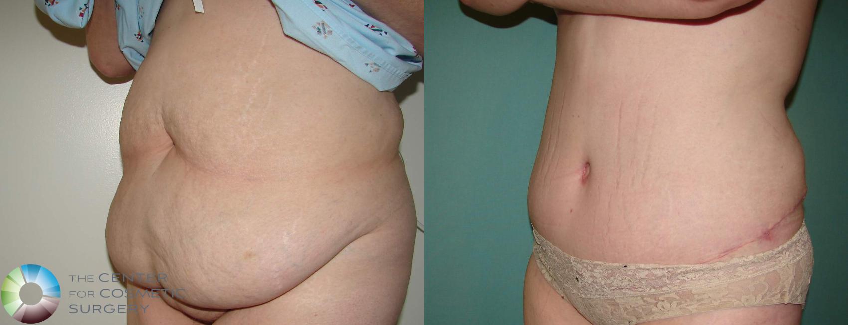 Before & After Tummy Tuck Case 639 View #2 View in Golden, CO