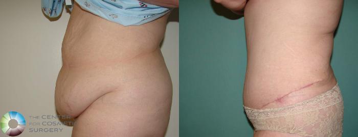 Before & After Tummy Tuck Case 639 View #3 in Denver, CO