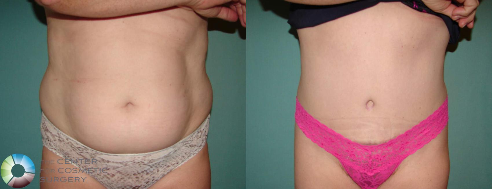 Before & After Tummy Tuck Case 645 View #1 in Denver and Colorado Springs, CO