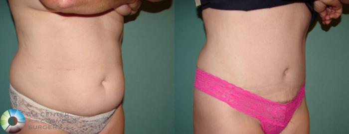Before & After Tummy Tuck Case 645 View #2 in Denver, CO
