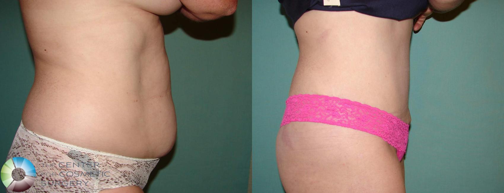 Before & After Tummy Tuck Case 645 View #3 View in Golden, CO