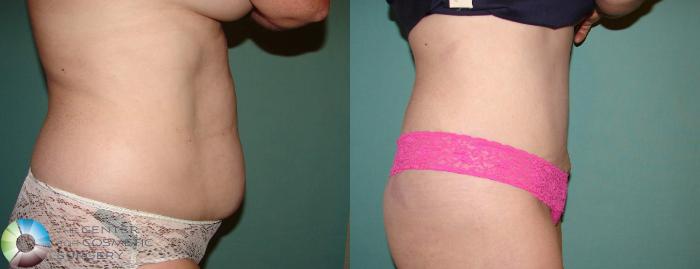 Before & After Tummy Tuck Case 645 View #3 in Denver, CO