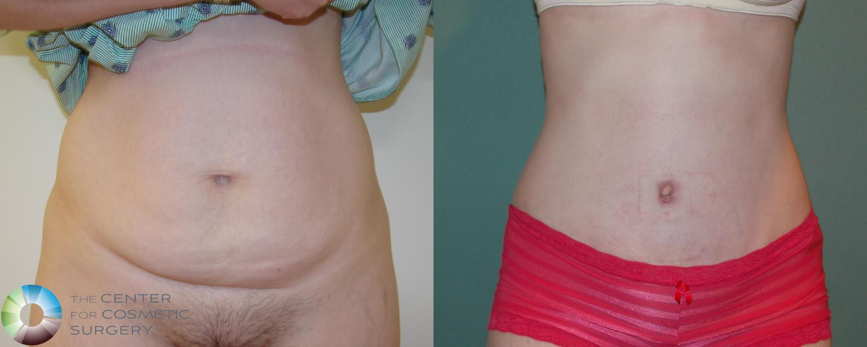 Tummy Tuck Before and After Pictures Case 11390, Denver, CO