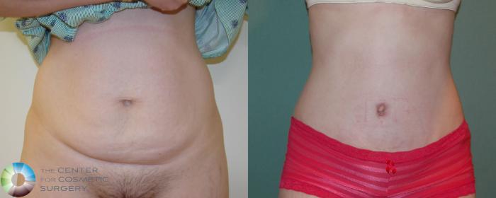 Before & After Tummy Tuck Case 675 View #1 View in Golden, CO