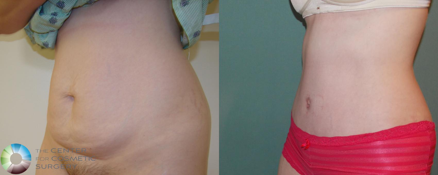 Before & After Tummy Tuck Case 675 View #2 in Denver and Colorado Springs, CO