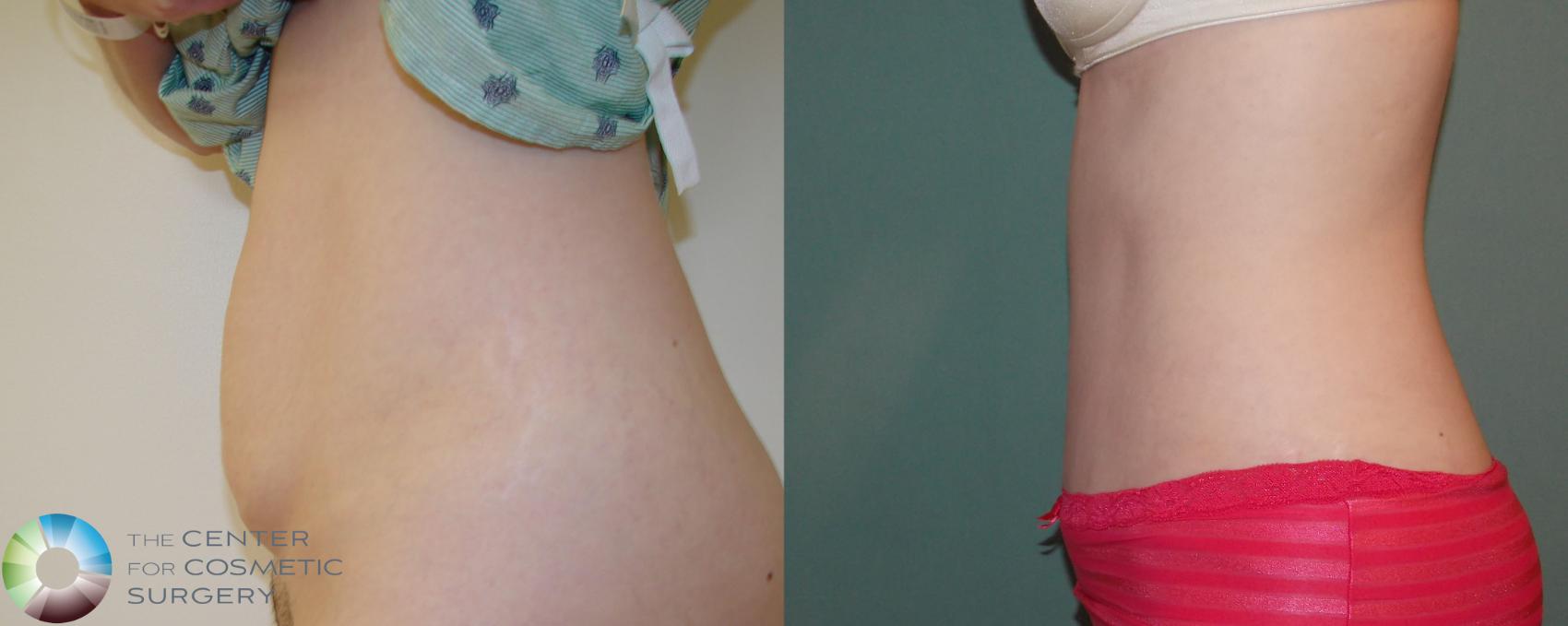 Before & After Tummy Tuck Case 675 View #3 in Denver and Colorado Springs, CO