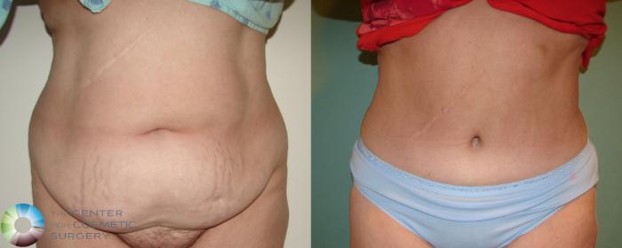 Before & After Tummy Tuck Case 676 View #1 in Denver, CO