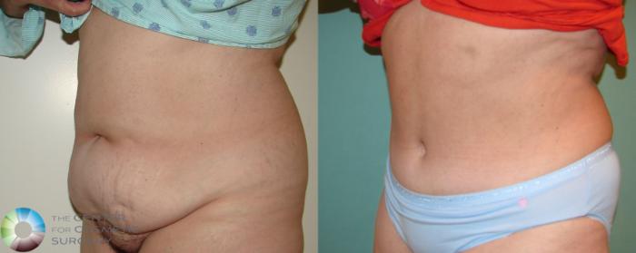 Before & After Tummy Tuck Case 676 View #2 in Denver, CO