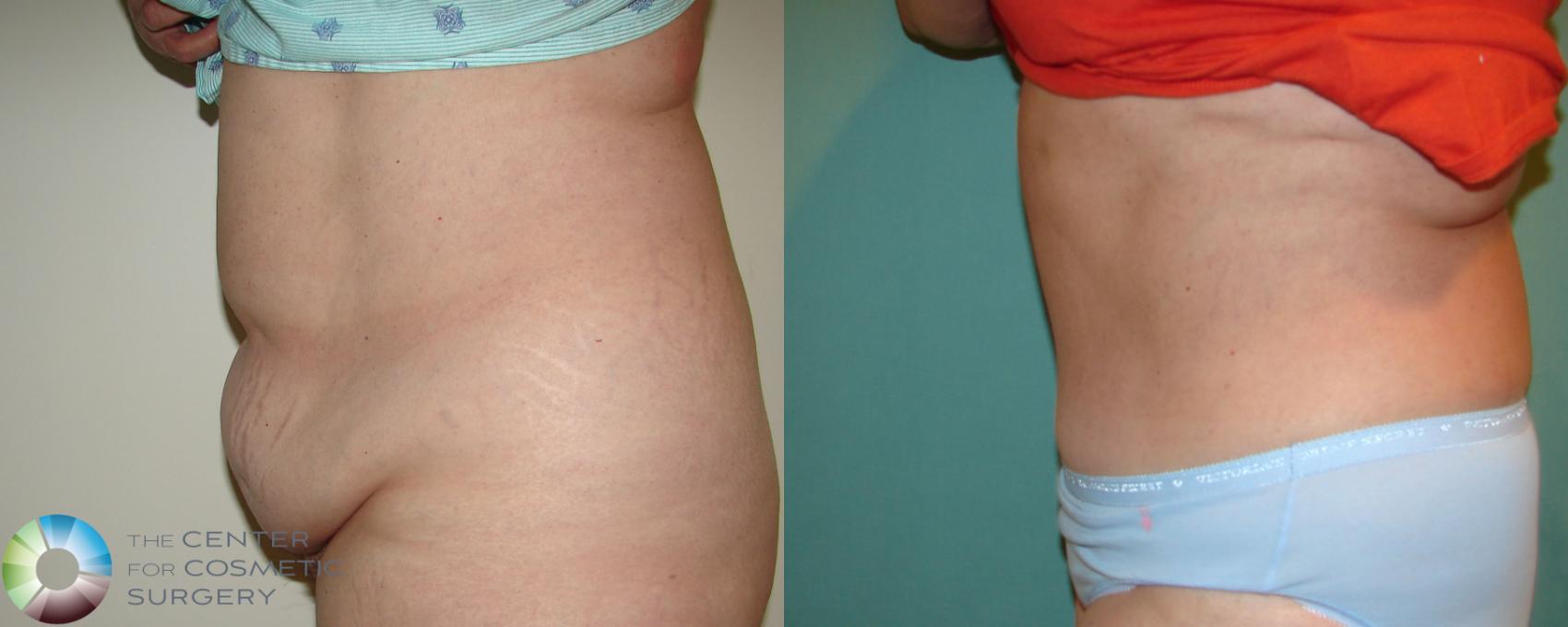 Before & After Tummy Tuck Case 676 View #3 View in Golden, CO
